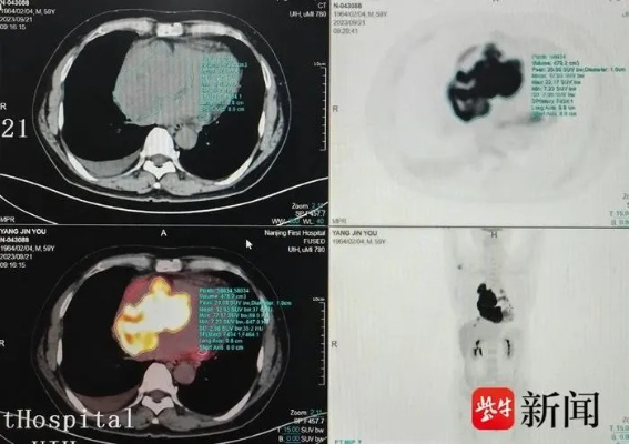 男子胸部脓液X光现刀留体内8年,奇迹避心脏血管惊现新疗法 男子胸部脓液X光现刀留体内8年,奇迹避心脏血管惊现新疗法