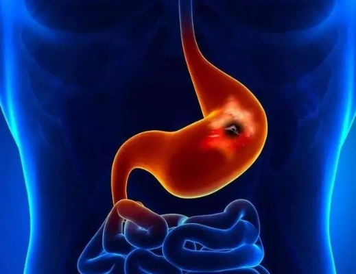 27岁女子胃萎缩暴瘦35斤离世，揭示健康危机新警示