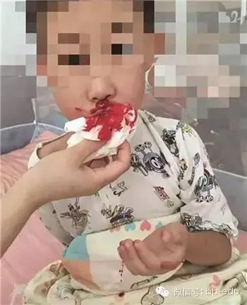 17岁少年血饮偏方惨中毒，揭秘健康误区代价惨重