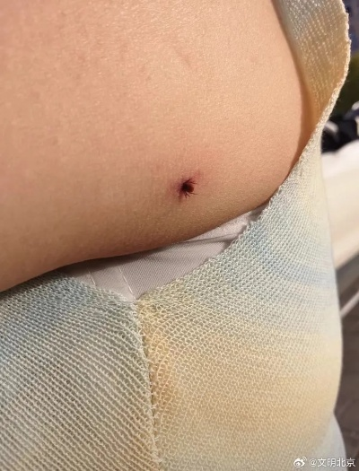 户外被蜱虫叮咬飞行员14天后烧烤汉堡致命之谜 户外被蜱虫叮咬飞行员14天后烧烤汉堡致命之谜