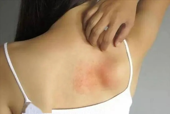 床上穿裤隐患大，易致皮肤瘙痒过敏风险高