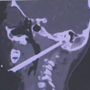 惊险！医术高超，医生妙手回春救颅底筷子伤者，守护生命奇迹！