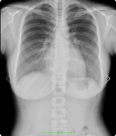 写真模特晒CT证“天然胸”引热议 脂肪丰胸CT难显影成关键