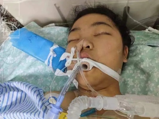 工人嘴清油管误吸柴油，现大面积白肺紧急入住 ICU