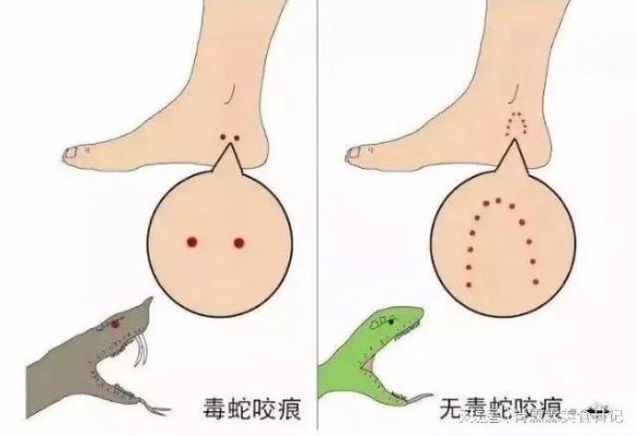 女童遭蛇咬后咬死蛇,蛇种鉴定+儿童蛇咬黄金10分钟急救全攻略 女童遭蛇咬后咬死蛇,蛇种鉴定+儿童蛇咬黄金10分钟急救全攻略