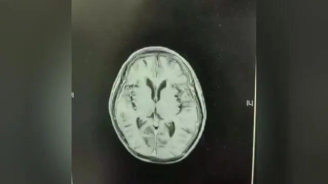 5米高坠男子感染超级细菌，高烧不止，脑脊液如果冻般浑浊