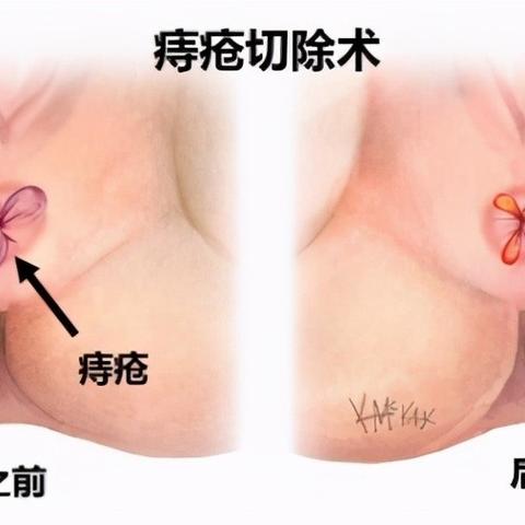 一周连做5场手术，包括痔疮切除、包皮环切，此男子堪称狠角色