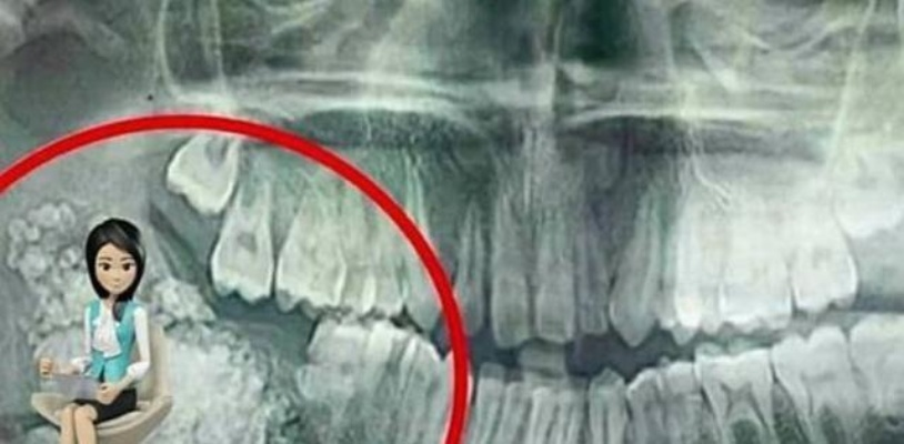 18岁少女跳操后腹痛不止,肿块里竟藏24颗牙齿 18岁少女跳操后腹痛不止,肿块里竟藏24颗牙齿