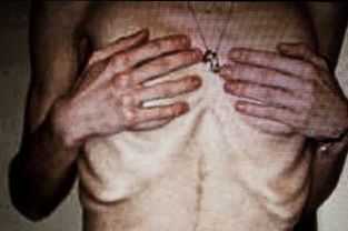 20岁女子营养不良瘦成皮包骨，竟因脂肪肝让病情雪上加霜