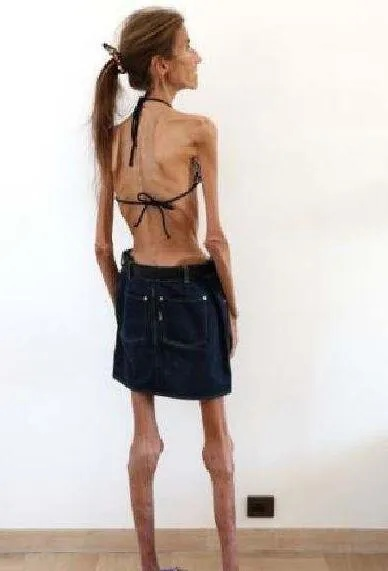 20岁女子瘦成皮包骨竟患脂肪肝，营养不良让病情雪上加霜