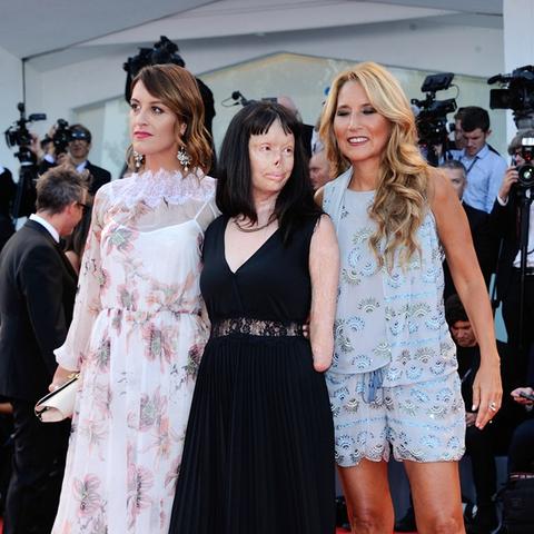 残障演员面部肿瘤走红毯被同行嘲笑，霸气回击震撼众人！