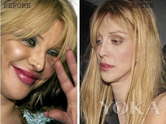 后悔整容！女星布鲁克斯・纳德如今皮肤坑坑洼洼，直言悔不当初