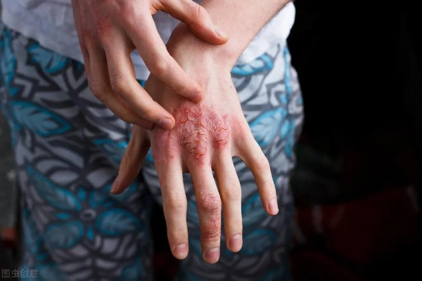 红斑狼疮夺命真相，周海媚病例警示与2026精准治疗新策略