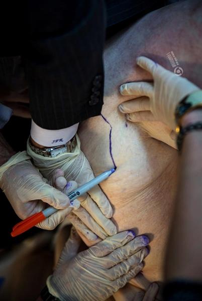 美国男子减重360磅后众筹割皮，感觉身体被困住了急需改变